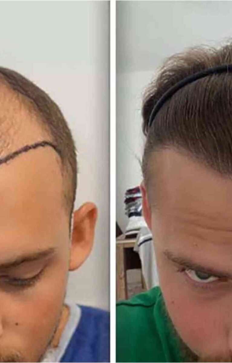 Best Hair Transplat Turkey