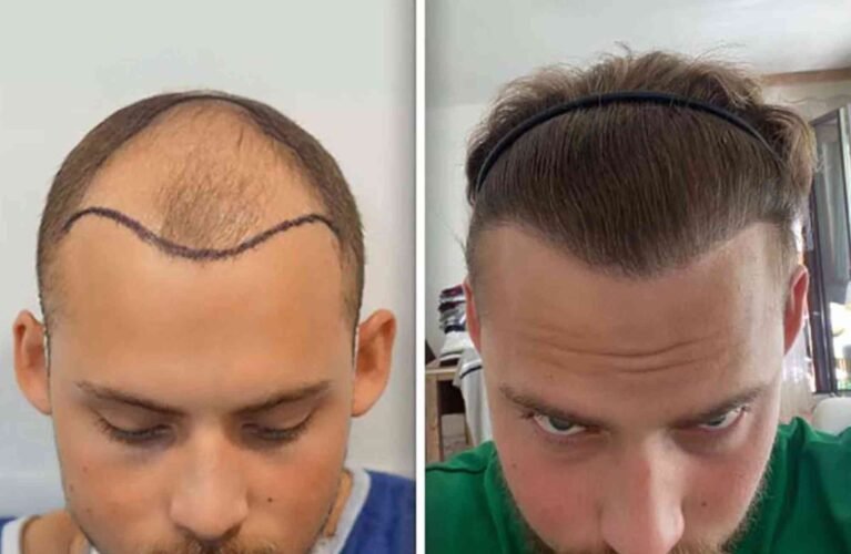 Best Hair Transplat Turkey